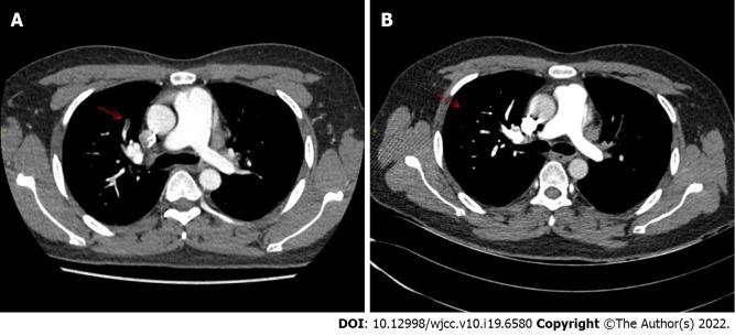 https://cdn.ncbi.nlm.nih.gov/pmc/blobs/8fab/9294875/b2cab809393e/WJCC-10-6580-g001.jpg