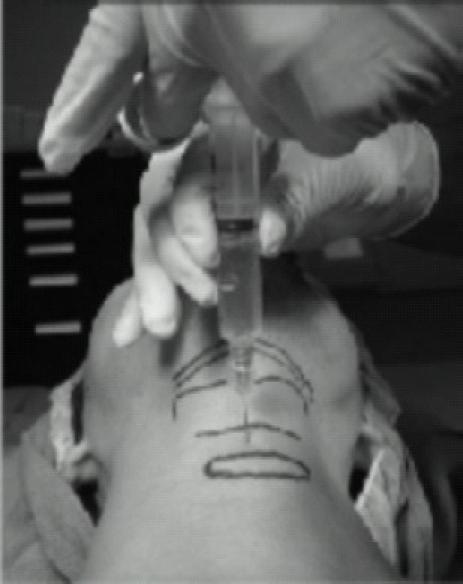 https://cdn.ncbi.nlm.nih.gov/pmc/blobs/8fd1/2900072/7ed84a4b6dac/IJA-53-641-g010.jpg