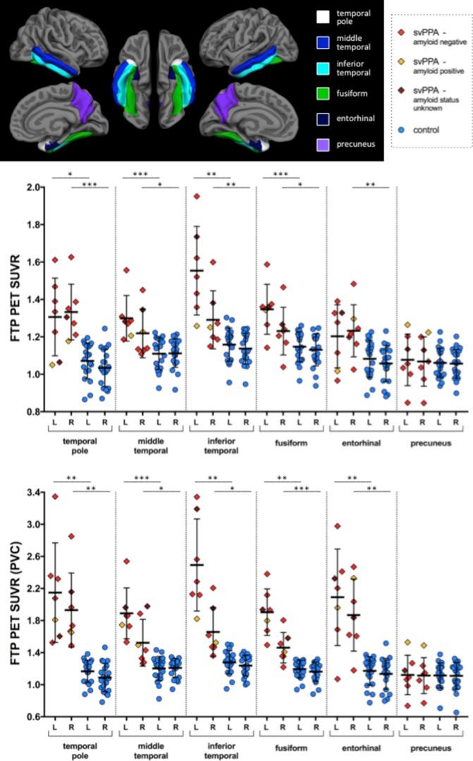 https://cdn.ncbi.nlm.nih.gov/pmc/blobs/8fd1/6166609/418ad7c85d40/jnnp-2017-316409f04.jpg