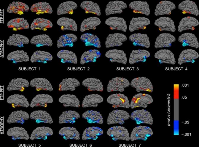 https://cdn.ncbi.nlm.nih.gov/pmc/blobs/8fd1/6166609/792c5f1ee1fa/jnnp-2017-316409f02.jpg