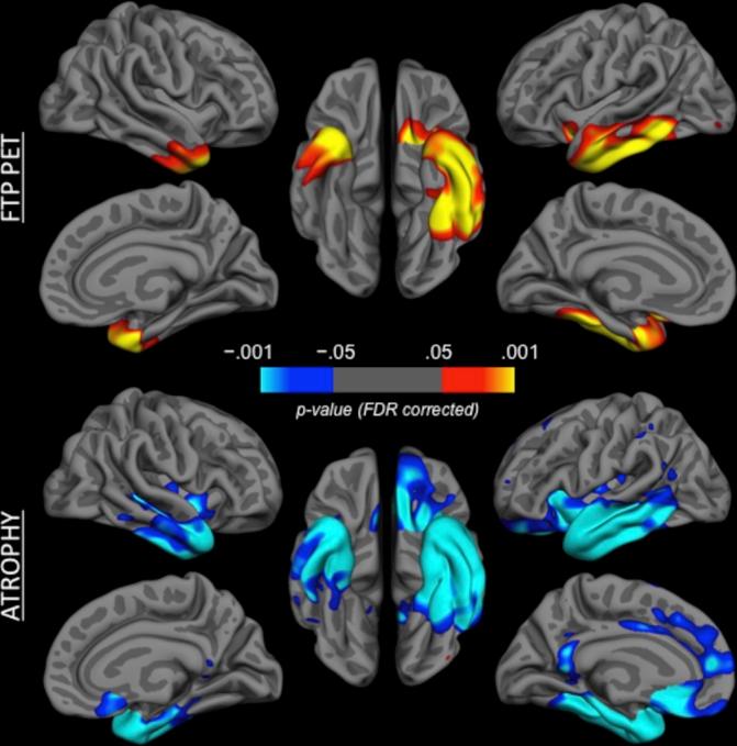 https://cdn.ncbi.nlm.nih.gov/pmc/blobs/8fd1/6166609/86f3c5fd8aeb/jnnp-2017-316409f03.jpg