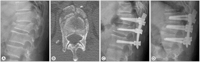 https://cdn.ncbi.nlm.nih.gov/pmc/blobs/8ffc/4217060/318f16abe3a2/jkns-56-230-g003.jpg