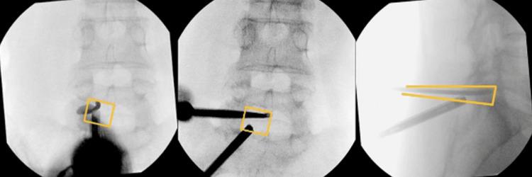 https://cdn.ncbi.nlm.nih.gov/pmc/blobs/9029/12306511/1af67db9f833/cureus-0017-00000086958-i07.jpg