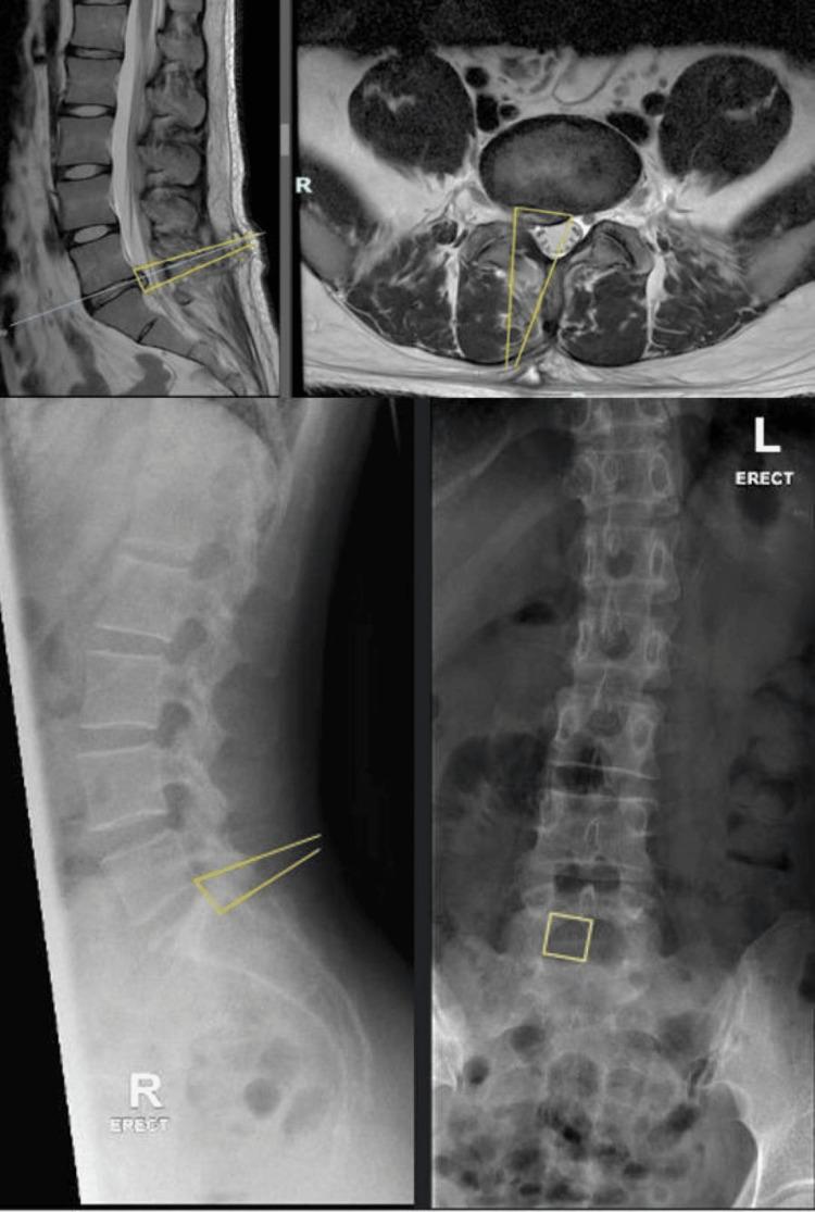 https://cdn.ncbi.nlm.nih.gov/pmc/blobs/9029/12306511/7592d537684d/cureus-0017-00000086958-i01.jpg