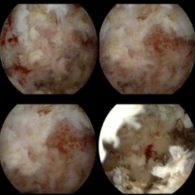 https://cdn.ncbi.nlm.nih.gov/pmc/blobs/9029/12306511/8ce9182df987/cureus-0017-00000086958-i05.jpg