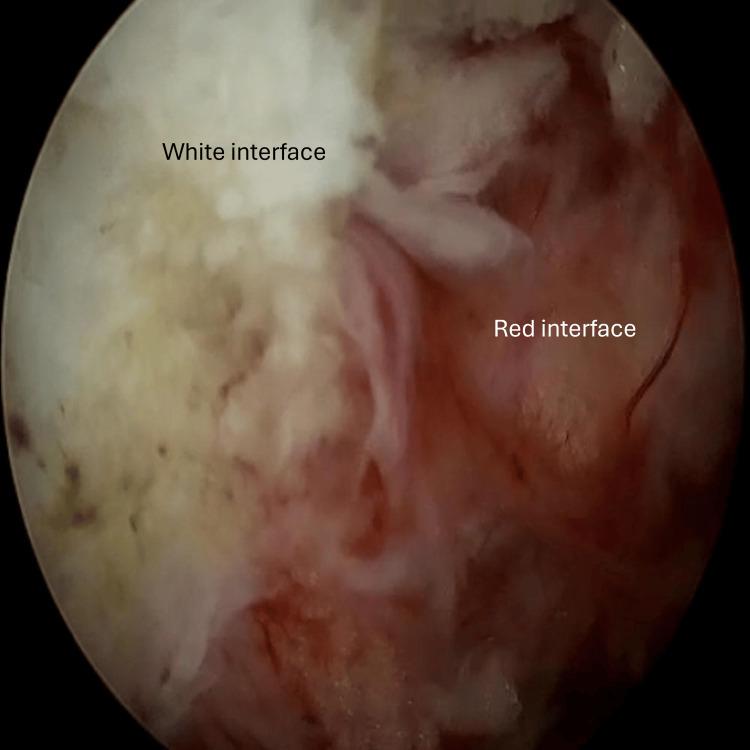 https://cdn.ncbi.nlm.nih.gov/pmc/blobs/9029/12306511/8e2bc3a2d9ac/cureus-0017-00000086958-i03.jpg