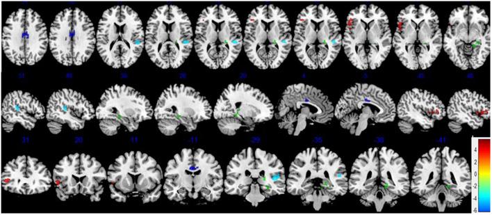 https://cdn.ncbi.nlm.nih.gov/pmc/blobs/9082/8416237/b4e9970a952e/fnagi-13-670332-g0002.jpg