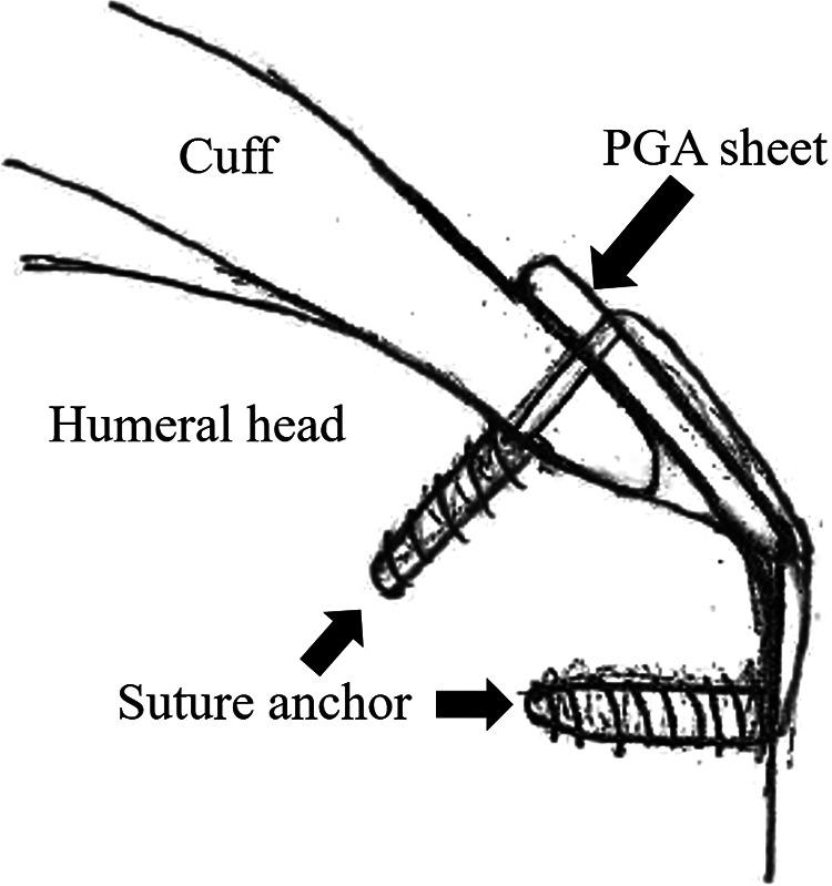 https://cdn.ncbi.nlm.nih.gov/pmc/blobs/90d0/7607773/1dd766d9dae9/10.1177_2325967120960166-fig5.jpg