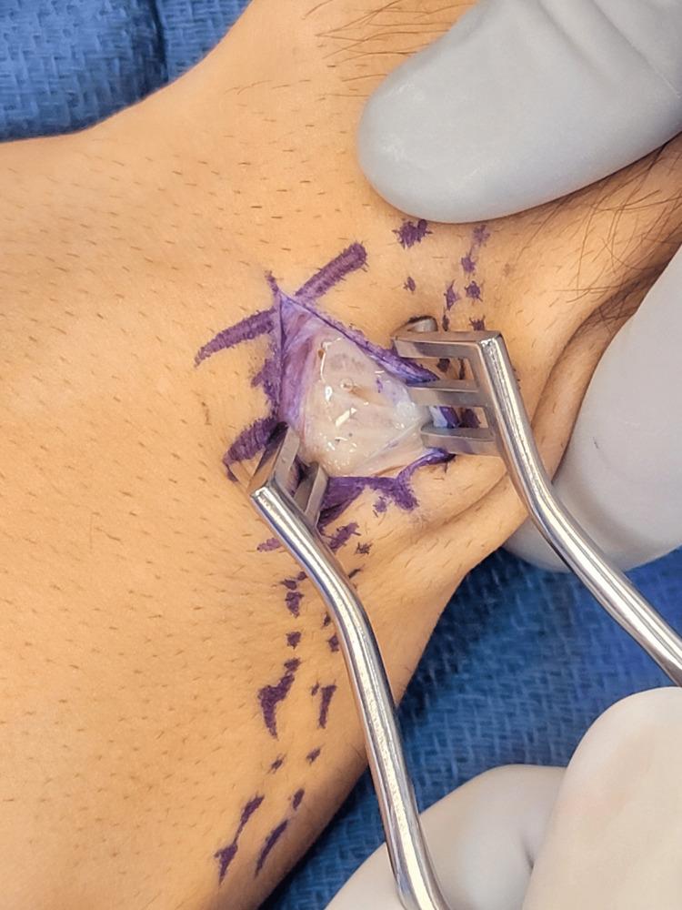 https://cdn.ncbi.nlm.nih.gov/pmc/blobs/9122/10148692/3e321af36c34/cureus-0015-00000036919-i05.jpg
