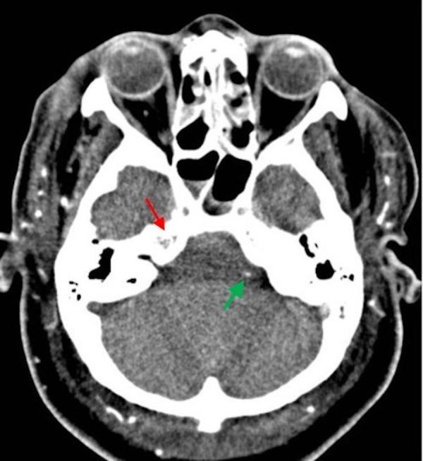 https://cdn.ncbi.nlm.nih.gov/pmc/blobs/9144/5605121/96b8ca2c59be/cureus-0009-00000001491-i04.jpg