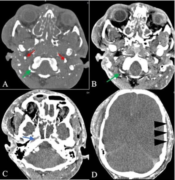 https://cdn.ncbi.nlm.nih.gov/pmc/blobs/9144/5605121/e1cbae63ba92/cureus-0009-00000001491-i01.jpg