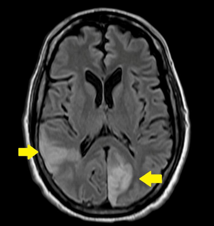 https://cdn.ncbi.nlm.nih.gov/pmc/blobs/914a/11214888/89fa6364d994/cureus-0016-00000063456-i03.jpg