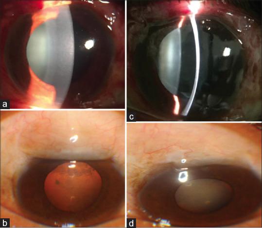 https://cdn.ncbi.nlm.nih.gov/pmc/blobs/9157/10433060/b76c30f93fd6/OJO-16-329-g003.jpg