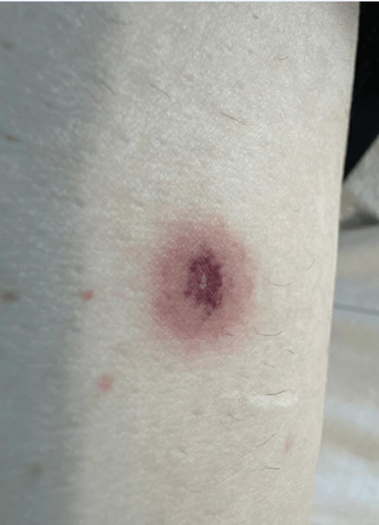 https://cdn.ncbi.nlm.nih.gov/pmc/blobs/9178/12085776/9e03f277fdb0/cureus-0017-00000082490-i02.jpg