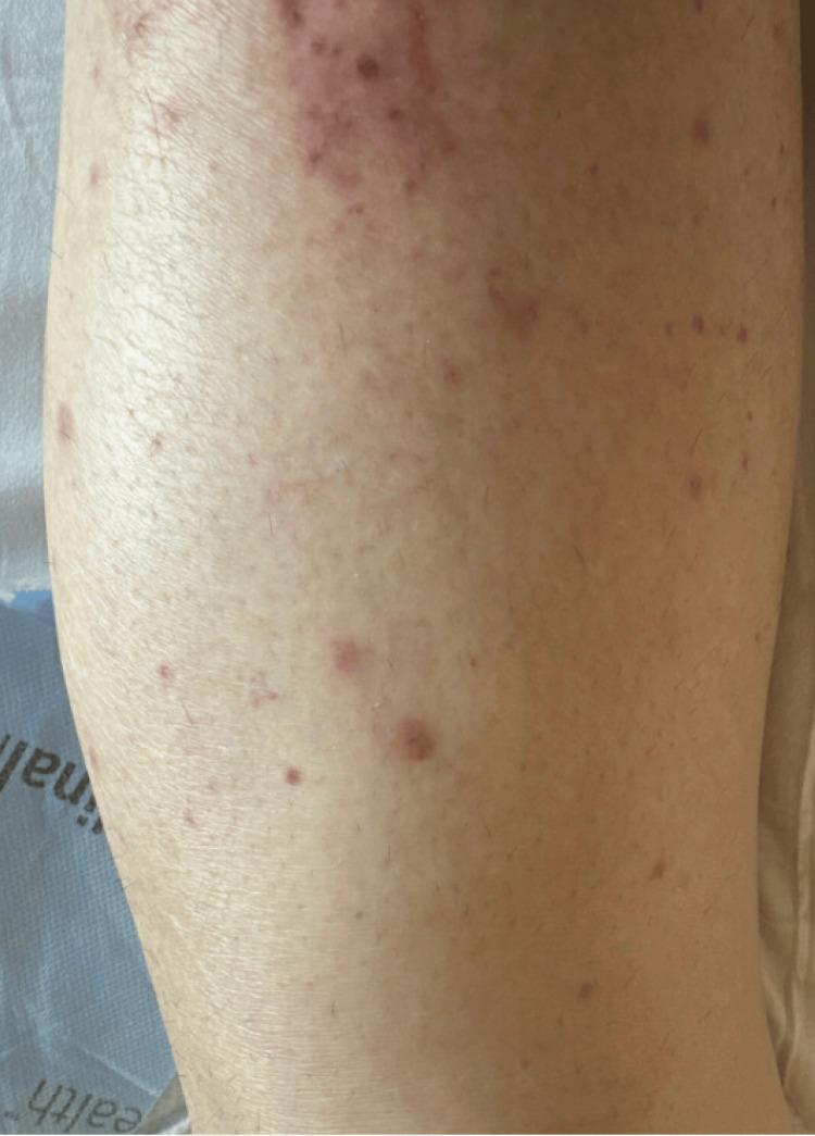 https://cdn.ncbi.nlm.nih.gov/pmc/blobs/9178/12085776/9f1651bb7beb/cureus-0017-00000082490-i04.jpg