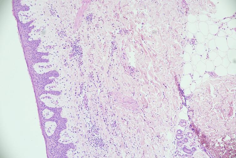 https://cdn.ncbi.nlm.nih.gov/pmc/blobs/918f/10188275/29839e4e04a9/cureus-0015-00000037639-i02.jpg