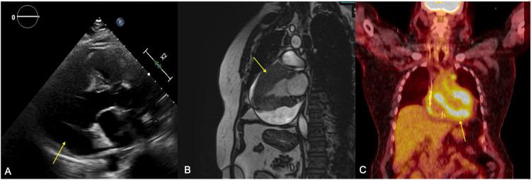 https://cdn.ncbi.nlm.nih.gov/pmc/blobs/9224/12011517/5ab96cead58b/cureus-0017-00000081012-i02.jpg