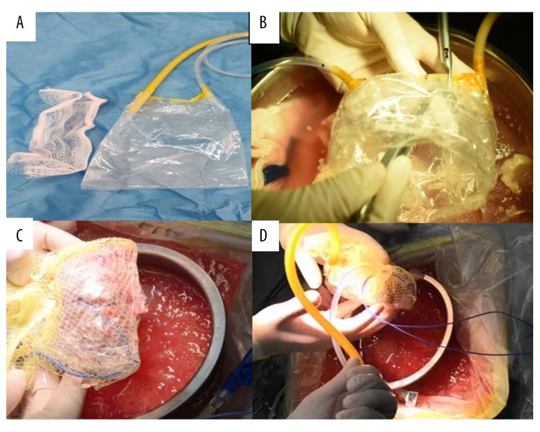 https://cdn.ncbi.nlm.nih.gov/pmc/blobs/9224/7706140/30c6d2d12e2b/anntransplant-25-e928773-g001.jpg