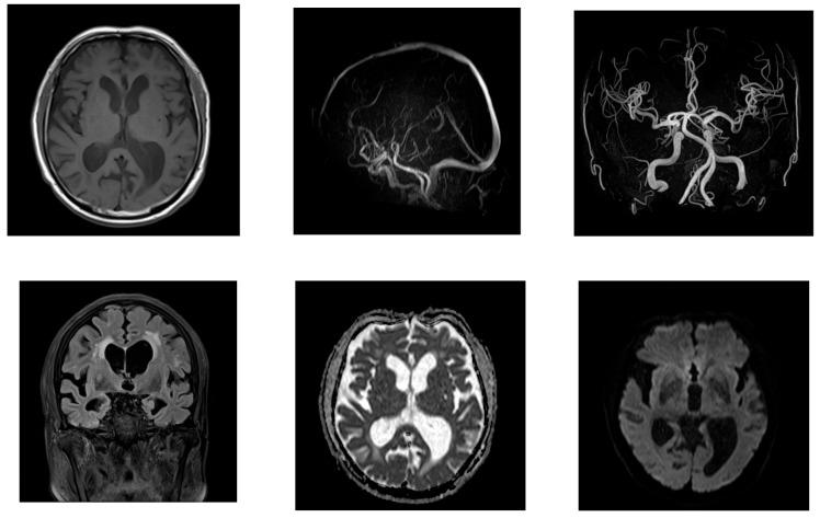 https://cdn.ncbi.nlm.nih.gov/pmc/blobs/922d/12196192/4eca27b7a314/neurolint-17-00086-g002.jpg