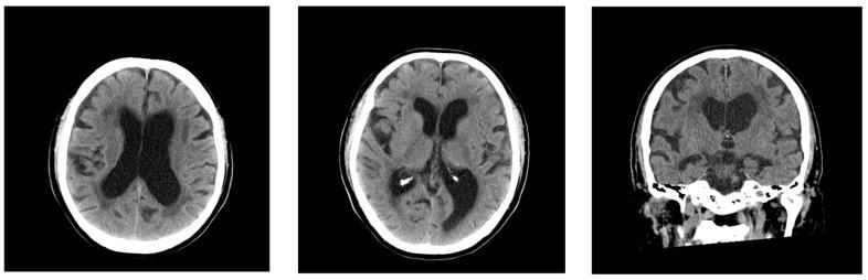 https://cdn.ncbi.nlm.nih.gov/pmc/blobs/922d/12196192/96353371468d/neurolint-17-00086-g001.jpg