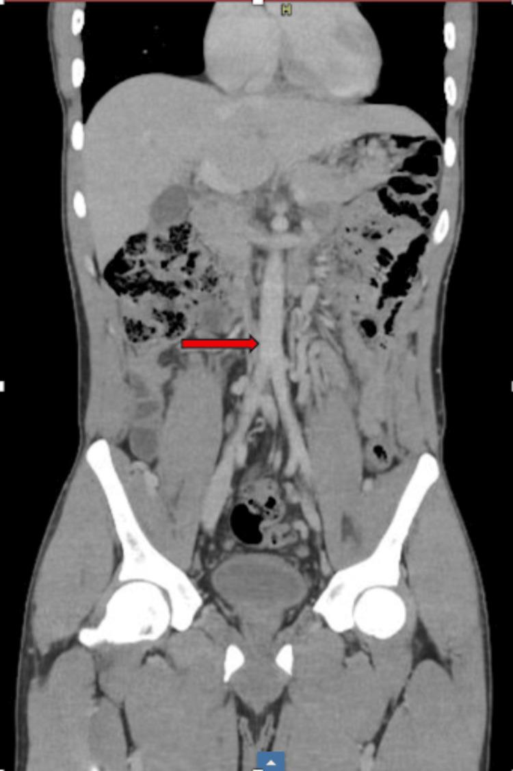 https://cdn.ncbi.nlm.nih.gov/pmc/blobs/9246/12301704/7be1ba12cf06/cureus-0017-00000086897-i01.jpg