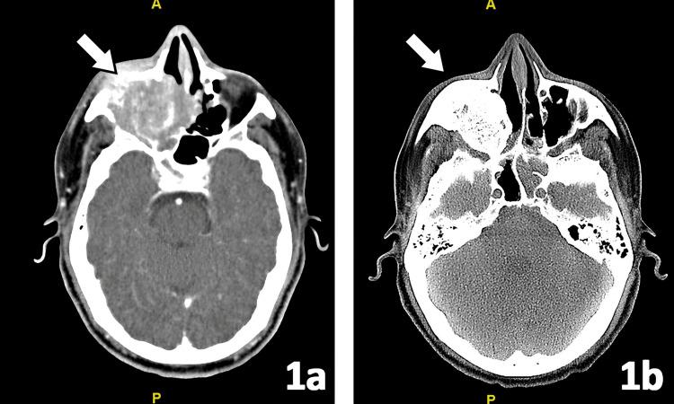 https://cdn.ncbi.nlm.nih.gov/pmc/blobs/9268/12354911/a03a9dc066d0/cureus-0017-00000087985-i01.jpg
