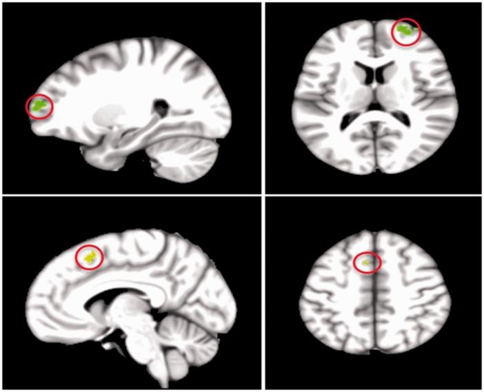 https://cdn.ncbi.nlm.nih.gov/pmc/blobs/9295/5824908/0738fb6719f7/10.1177_2055217318760641-fig1.jpg