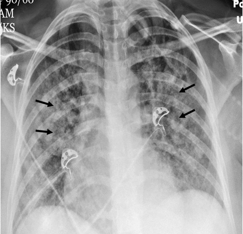 https://cdn.ncbi.nlm.nih.gov/pmc/blobs/9337/7243639/e9cb95e16a46/cureus-0012-00000007769-i01.jpg