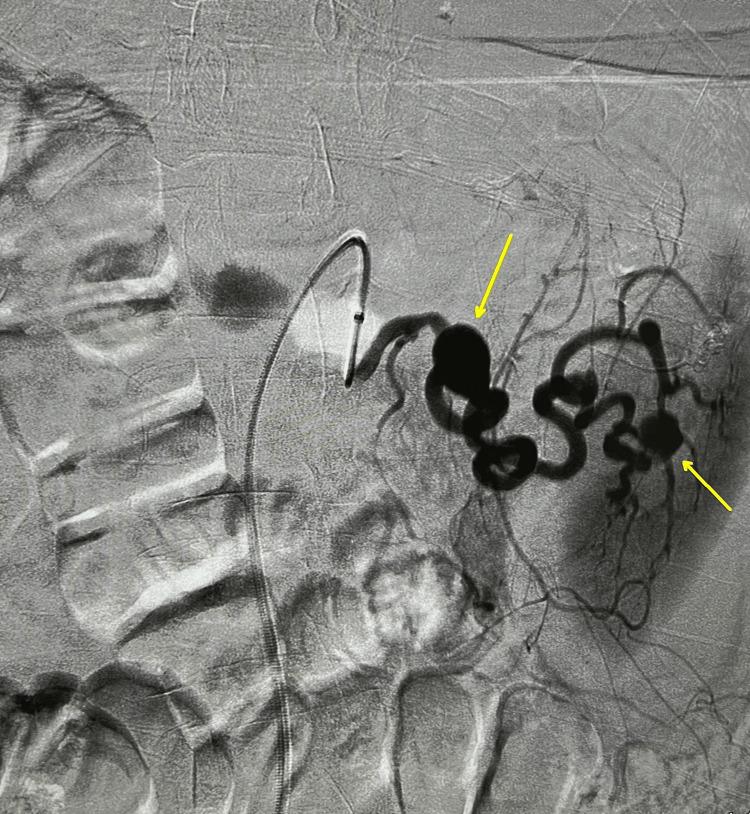https://cdn.ncbi.nlm.nih.gov/pmc/blobs/9347/11192427/1f8f32b1bb88/cureus-0016-00000060868-i02.jpg