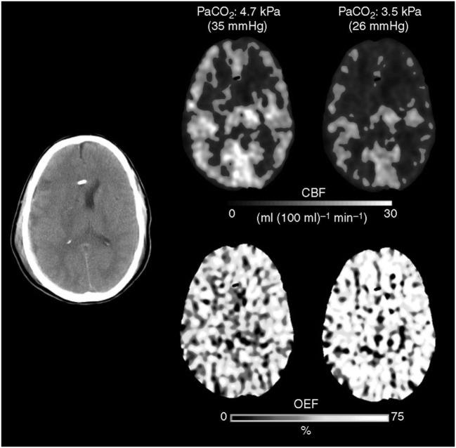 https://cdn.ncbi.nlm.nih.gov/pmc/blobs/9349/5511895/e7ed354ce66c/fneur-08-00250-g004.jpg