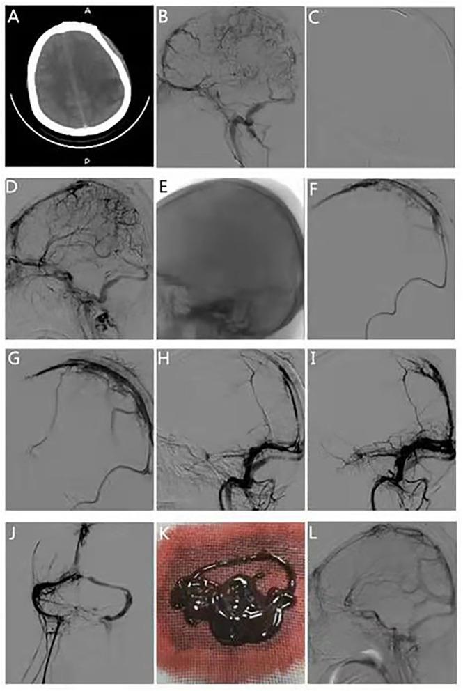 https://cdn.ncbi.nlm.nih.gov/pmc/blobs/93c4/8821095/9510446e8f1e/fneur-12-783380-g0002.jpg