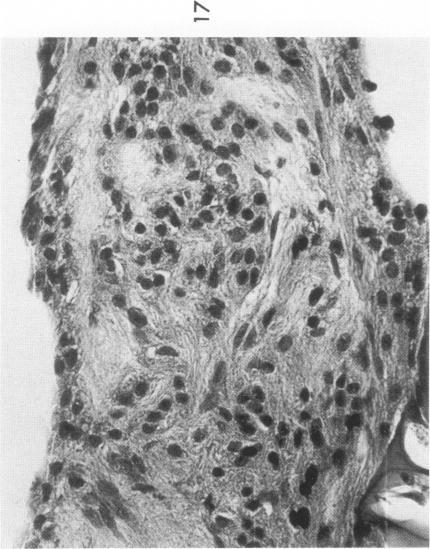 https://cdn.ncbi.nlm.nih.gov/pmc/blobs/93c8/1912641/60d439c5c66c/amjpathol00461-0174-b.jpg