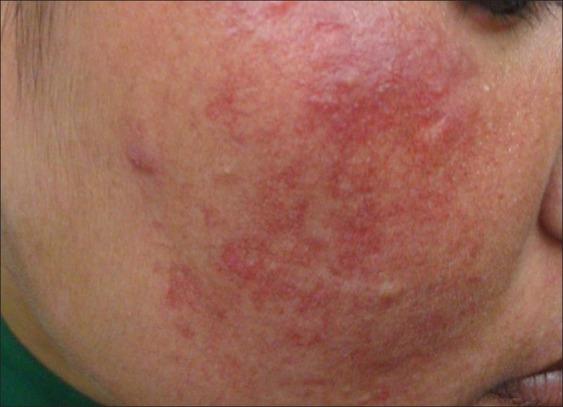 https://cdn.ncbi.nlm.nih.gov/pmc/blobs/9402/3401837/1c24a52acfce/IJD-57-251-g008.jpg