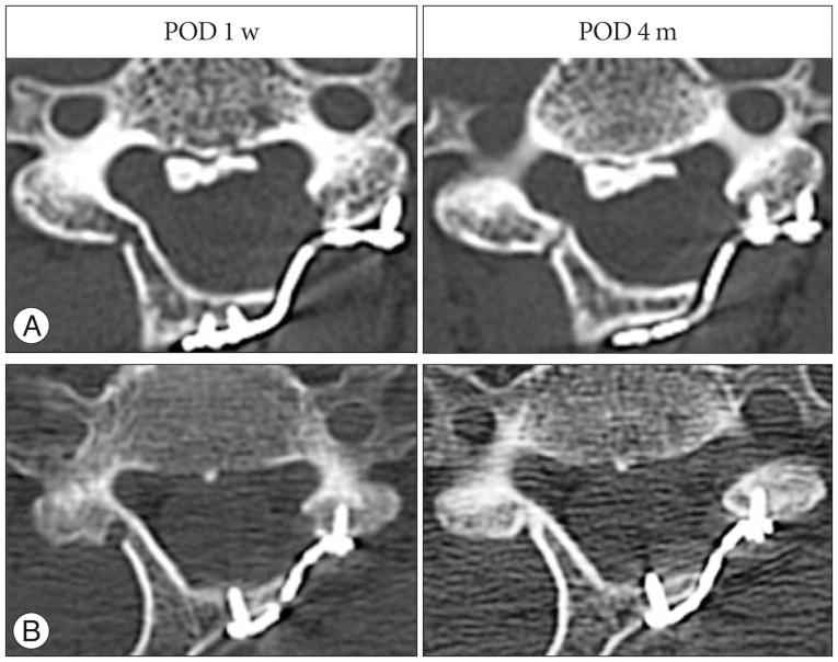 https://cdn.ncbi.nlm.nih.gov/pmc/blobs/944a/4954885/74074b5f87e8/jkns-59-368-g002.jpg
