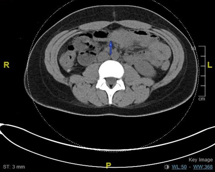 https://cdn.ncbi.nlm.nih.gov/pmc/blobs/944b/9067348/06a990e5bb78/cureus-0014-00000023792-i04.jpg