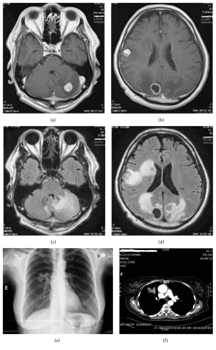 https://cdn.ncbi.nlm.nih.gov/pmc/blobs/944e/5352873/67c2ca29ab15/CRIONM2017-8654326.001.jpg
