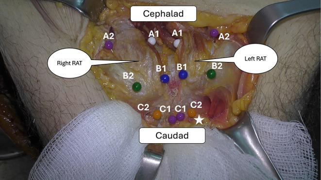 https://cdn.ncbi.nlm.nih.gov/pmc/blobs/94b0/11744990/4a4013ce5712/sicotj-11-4-fig2.jpg