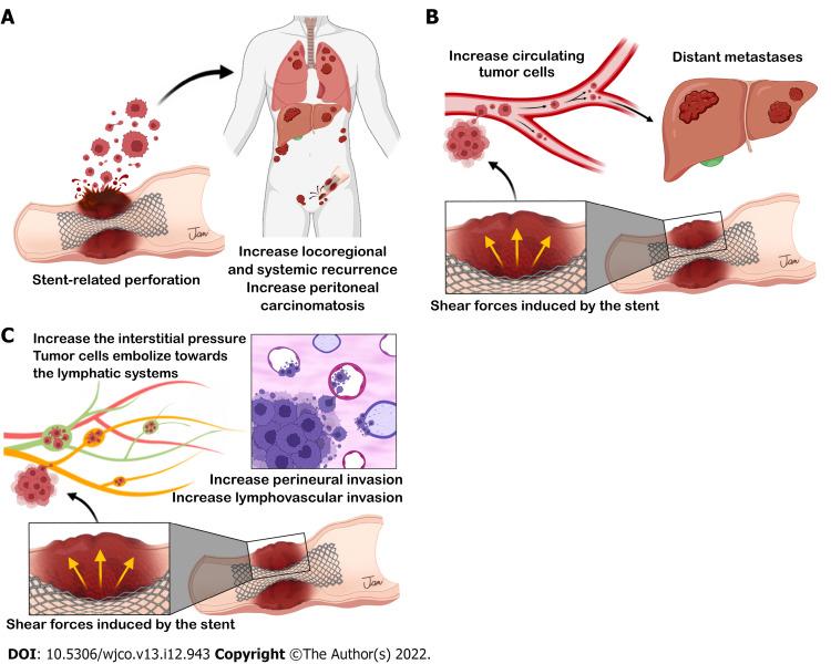 https://cdn.ncbi.nlm.nih.gov/pmc/blobs/94cd/9813833/cea6dd0bf469/WJCO-13-943-g006.jpg