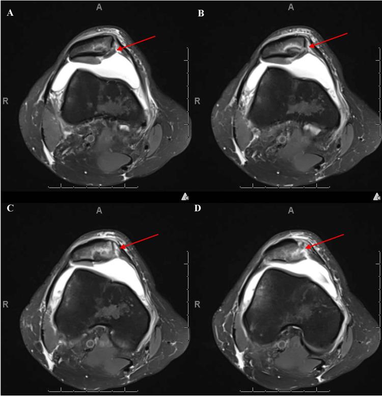 https://cdn.ncbi.nlm.nih.gov/pmc/blobs/94f2/12470478/4b61a8090d79/cureus-0017-00000091128-i02.jpg