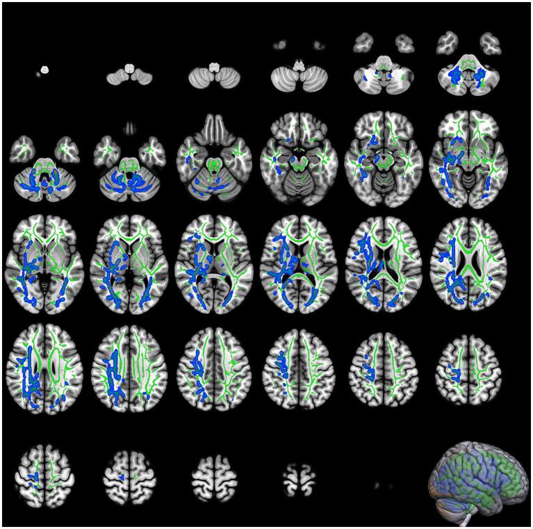 https://cdn.ncbi.nlm.nih.gov/pmc/blobs/94fc/12316184/49187c556295/fneur-16-1580262-g002.jpg