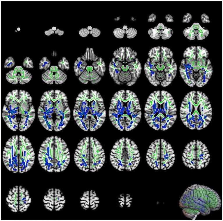 https://cdn.ncbi.nlm.nih.gov/pmc/blobs/94fc/12316184/559656f22572/fneur-16-1580262-g003.jpg