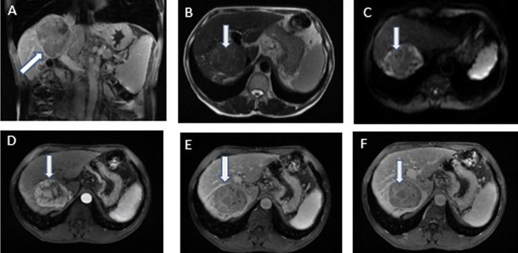 https://cdn.ncbi.nlm.nih.gov/pmc/blobs/951e/10829059/041f33609fb3/cureus-0016-00000051443-i01.jpg