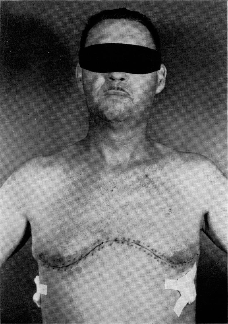 https://cdn.ncbi.nlm.nih.gov/pmc/blobs/9561/1613516/b4da0e0b8479/annsurg01304-0120-a.jpg