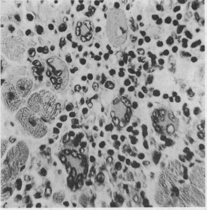 https://cdn.ncbi.nlm.nih.gov/pmc/blobs/959e/503332/e74562229ee1/brheartj00338-0150-b.jpg