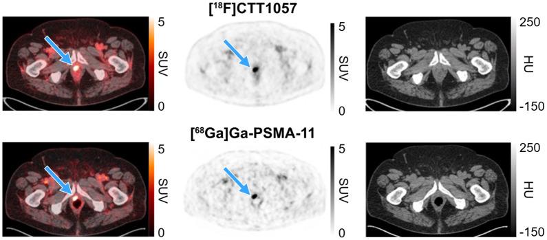 https://cdn.ncbi.nlm.nih.gov/pmc/blobs/95aa/12320562/a977374b9aa3/jnumed.124.269266f1.jpg