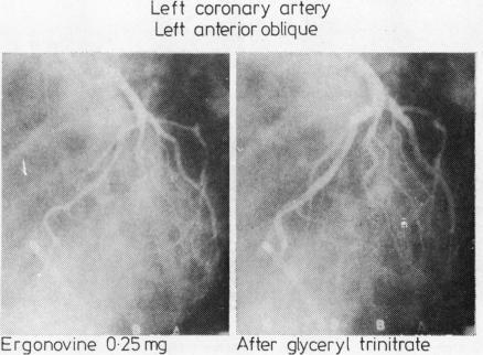 https://cdn.ncbi.nlm.nih.gov/pmc/blobs/95de/482578/5a5e28a617a9/brheartj00184-0031-a.jpg