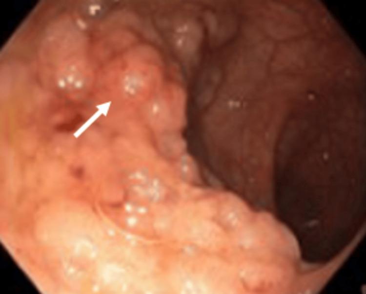 https://cdn.ncbi.nlm.nih.gov/pmc/blobs/95e0/12101811/29a7140d1616/cureus-0017-00000082857-i05.jpg