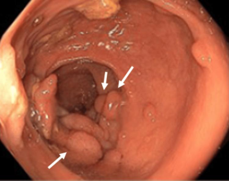 https://cdn.ncbi.nlm.nih.gov/pmc/blobs/95e0/12101811/b11af1b6de83/cureus-0017-00000082857-i04.jpg