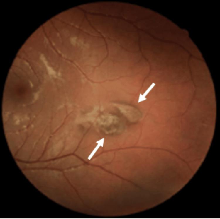 https://cdn.ncbi.nlm.nih.gov/pmc/blobs/95e0/12101811/d4e088583e21/cureus-0017-00000082857-i03.jpg