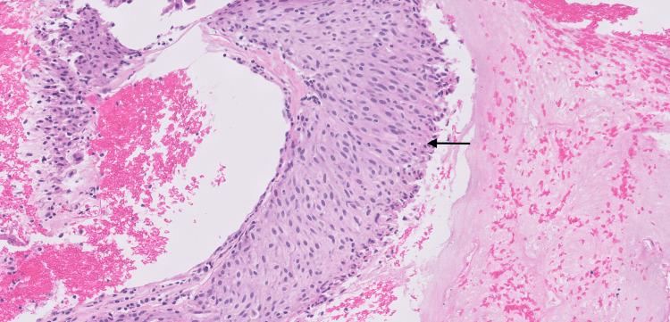 https://cdn.ncbi.nlm.nih.gov/pmc/blobs/95ed/9949736/11fb89b6aa6d/cureus-0015-00000034164-i02.jpg